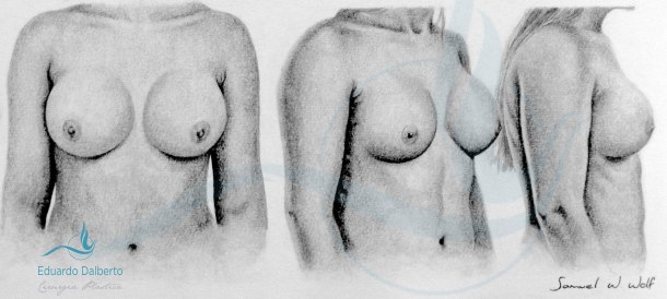 Mamoplastia de Aumento